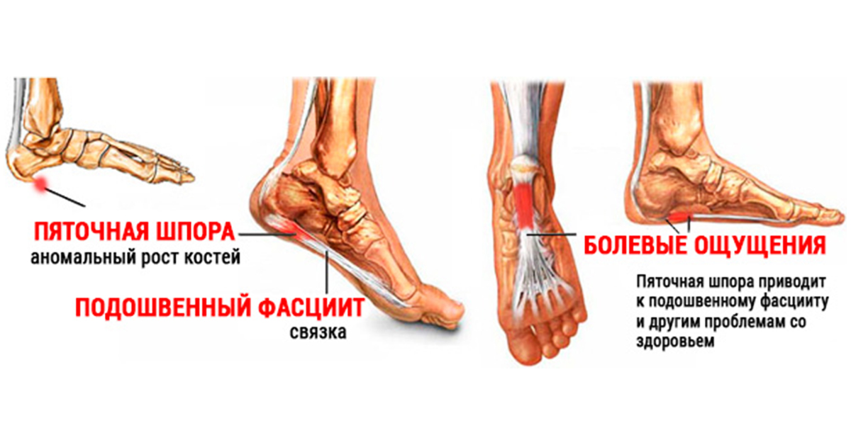 Пятка шпора