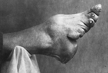 Китайские "лотосовые ножки" -"lily feet"- и ужасающие подробности этого обычая Китайские "лотосовые ножки" -"lily feet"- и ужасающие подробности этого обычая