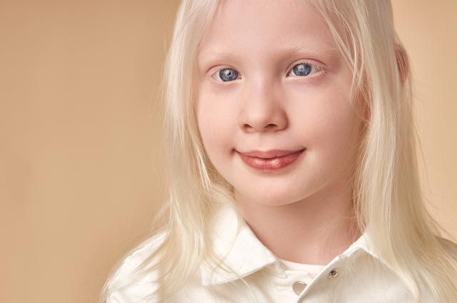 Что такое альбинизм