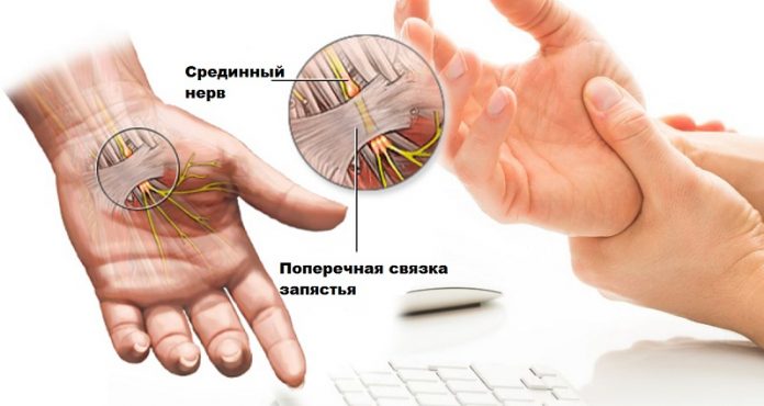 carpal-tunnel