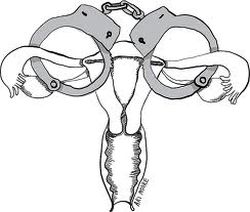 «Принудительная стерилизация» в США «Принудительная стерилизация» в США