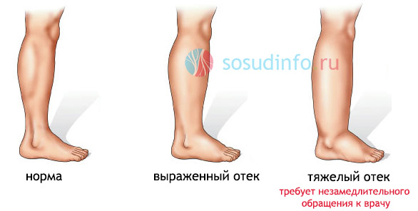 Чем снять отек ног при варикозе в домашних условиях Чем снять отек ног при варикозе в домашних условиях