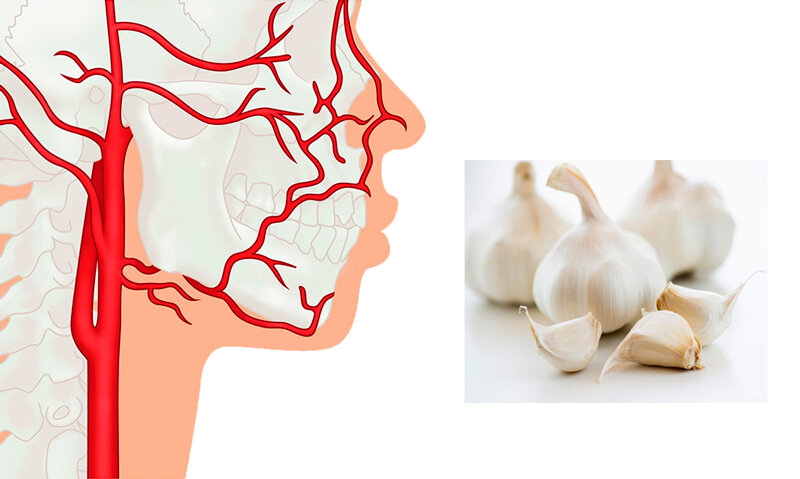 Чистка сосудов дома: от атеросклероза, головных болей и других заболеваний