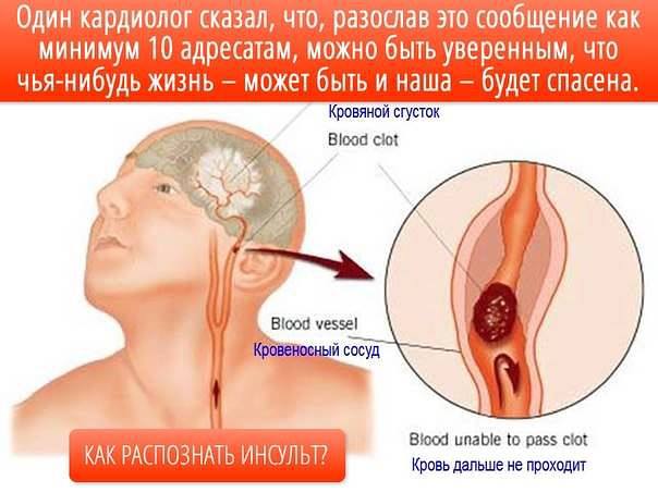 Распознавание симптомов инсульта