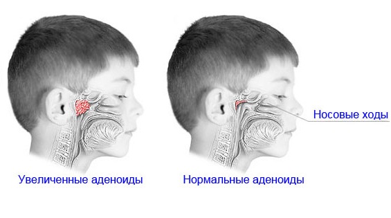 Аденоиды - норма и увеличенные