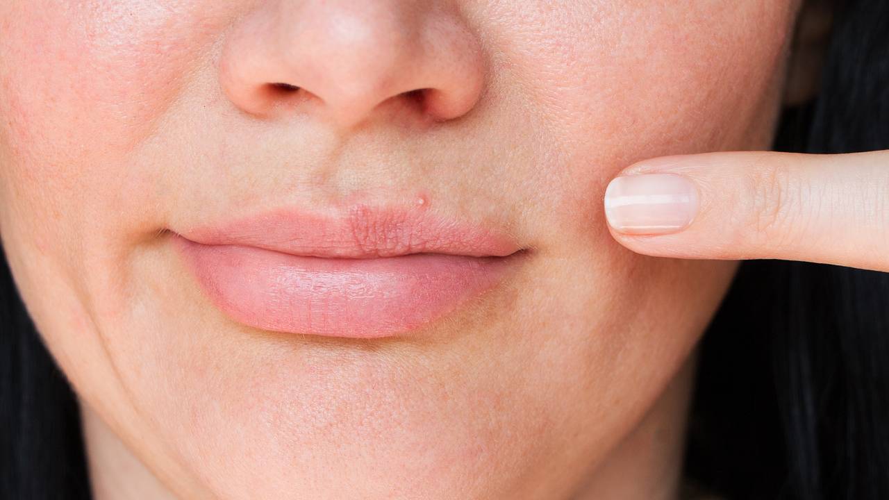 Врач предостерег от выдавливания прыщей в «треугольнике смерти»