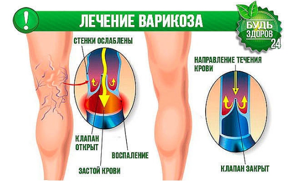 Вены На Ногах Жить Здорово