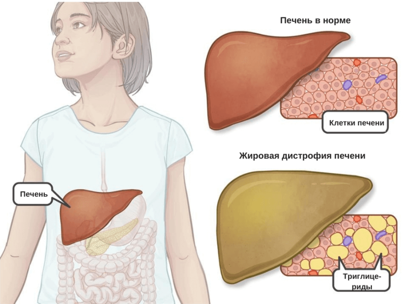 Как поддержать печень при жировой болезни