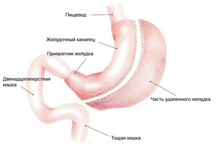 растянула желудок как уменьшить