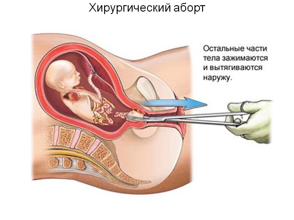 Беременность после позднего выкидыша и чистки Беременность после позднего выкидыша и чистки