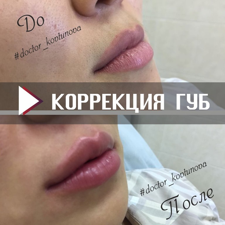Коррекция губ