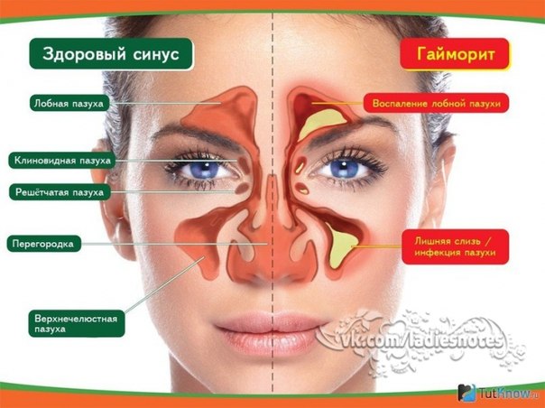НАРОДНЫЕ МЕТОДЫ ЛЕЧЕНИЯ ГАЙМОРИТА НАРОДНЫЕ МЕТОДЫ ЛЕЧЕНИЯ ГАЙМОРИТА