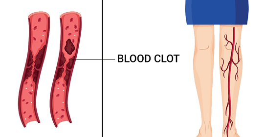 10 симптомов раннего предупреждения о сгустках в крови, которые вы никогда не должны игнорировать