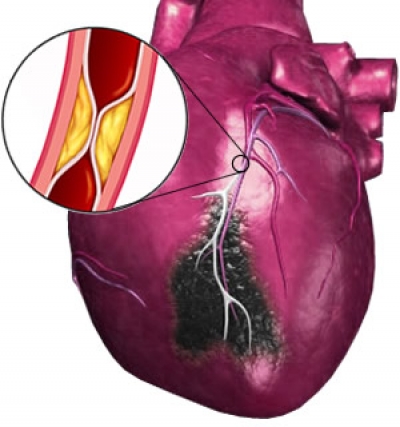 thesis submetted myocardial infarction thesis submetted myocardial infarction