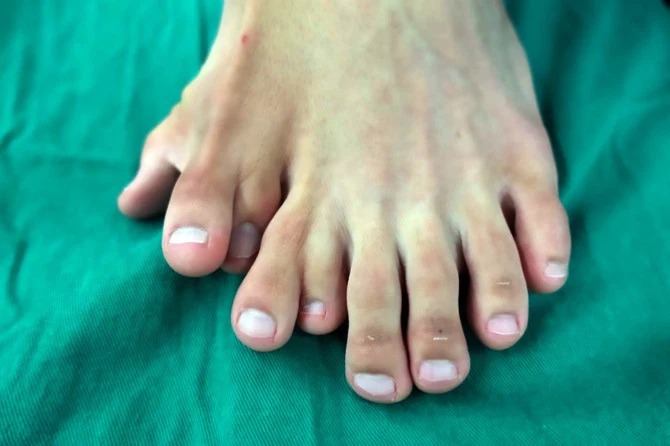 Счастья много не бывает: китаец долго жил с 14 пальцами на ногах, считая аномалию счастливым знаком