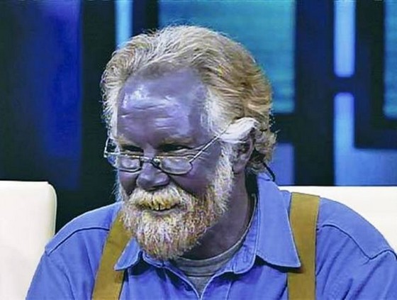 Человек с редким заболеванием - серебряной кожей Человек с редким заболеванием - серебряной кожей
