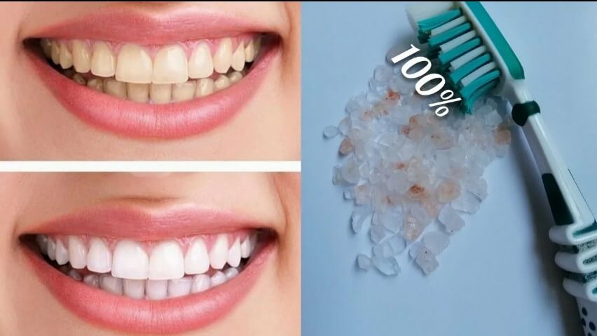 Стоматолог рассказала об опасности домашних методов отбеливания зубов