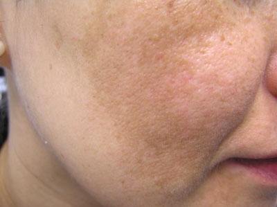 melasma-face