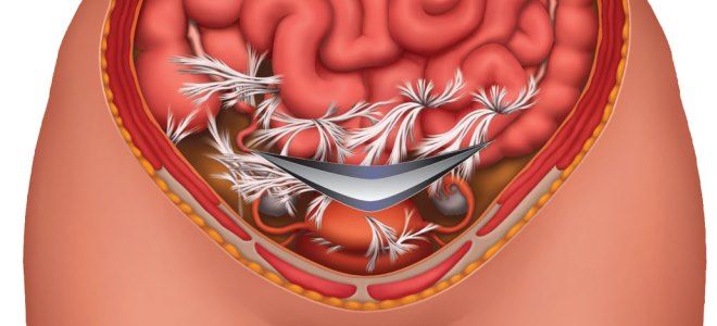 спаечный процесс в малом тазу