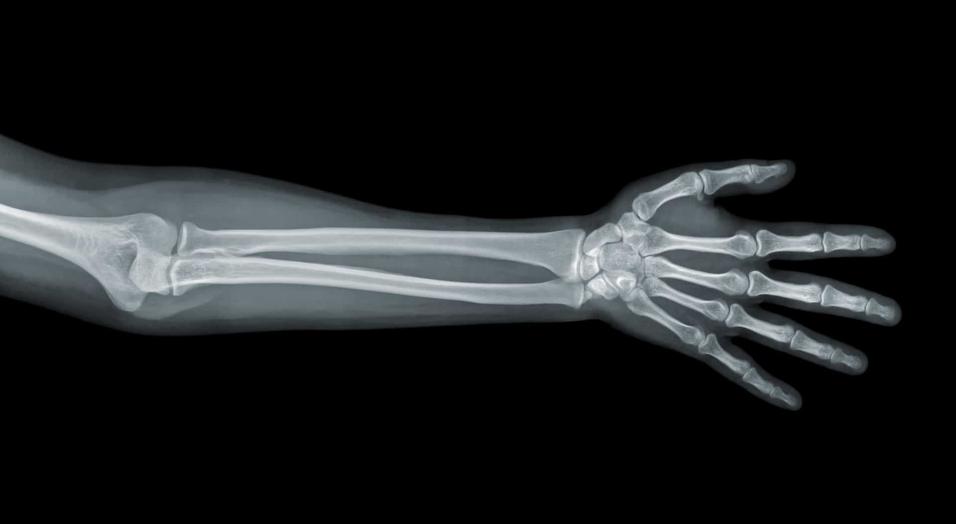 Рентген здоровой кисти правой руки
