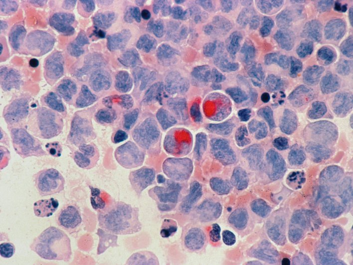 COVID-19 и грипп могут «разбудить» спящие раковые клетки и вызвать новые опухоли