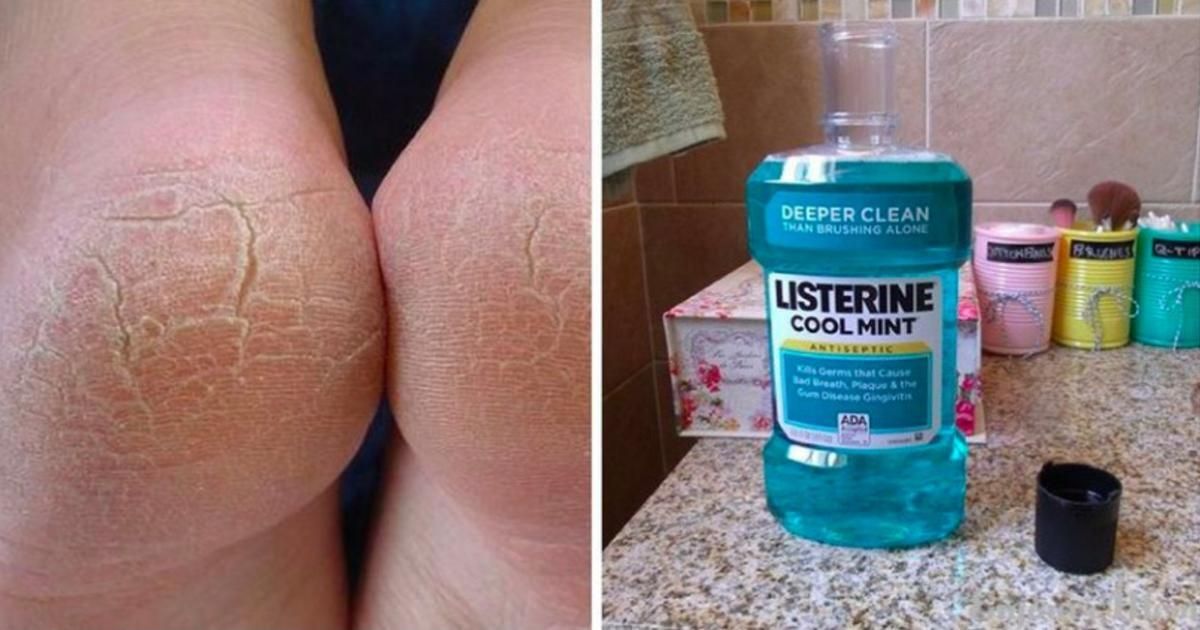 Удивительные способы использование Listerine, о которых должна знать каждая женщина Удивительные способы использование Listerine, о которых должна знать каждая женщина