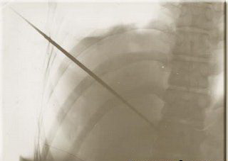 рентгеновский снимок рапиры в теле Мирина Дажо
