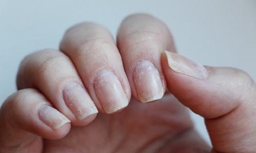 Почему портятся ногти после гель-лака. Пропилы ногтевой пластины: причины, последствия, восстановление