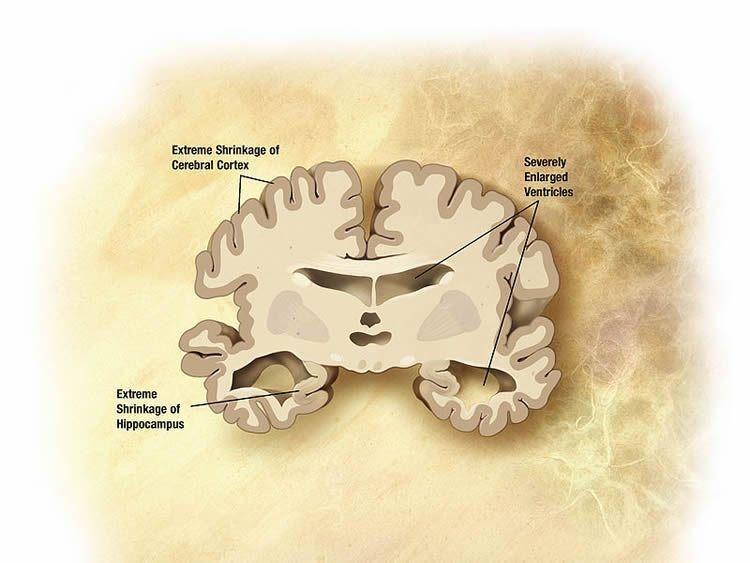 Нейродегенеративные изменения в мозге при болезни Альцгеймера