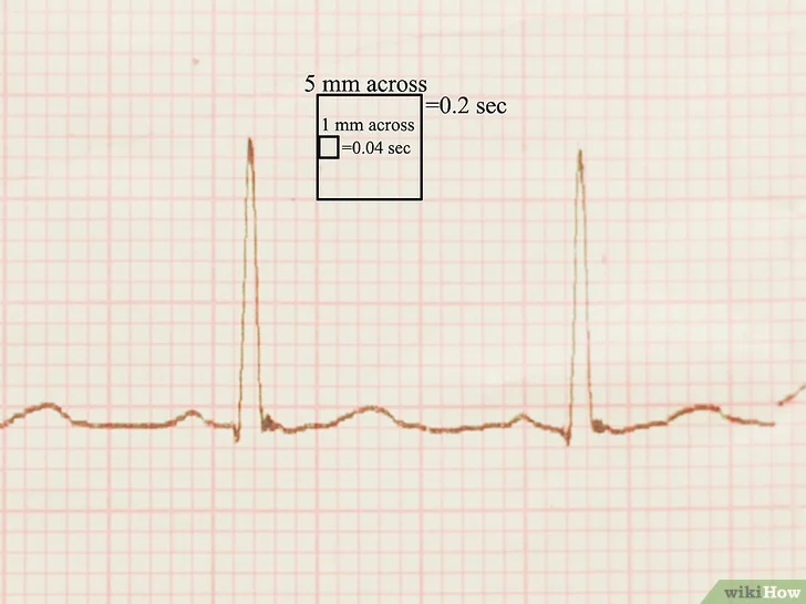 Изображение с названием Read an EKG Step 2