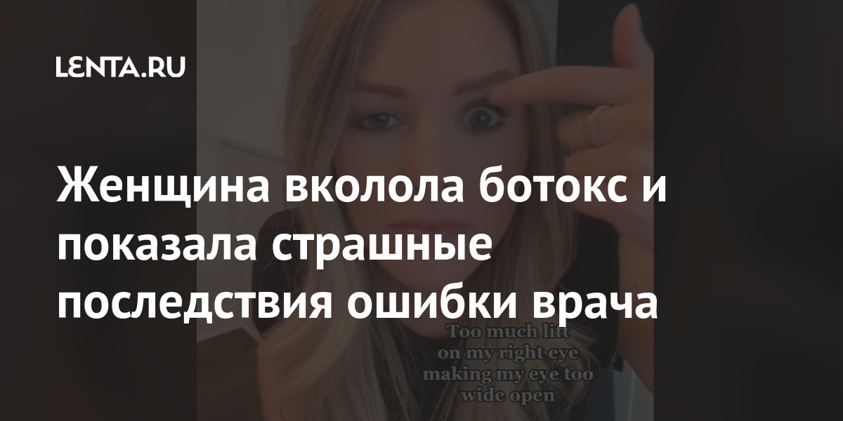 Женщина вколола ботокс и показала страшные последствия ошибки врача ботокс, месяцев, улыбку, процедуры, результат, исправить, кадрах, десневую, показала, панических, писали, клинику, пришла, drearandolph, никнеймом, Пользовательница, Косметолог, огорчивший, засняла, сделала