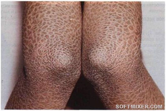 ichthyosis lamellaris 2