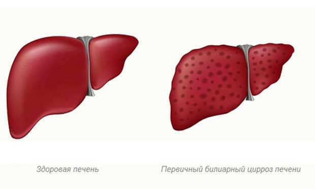 Здоровая печень и первичный билиарный цирроз печени