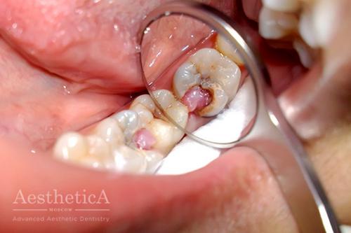 Воспаление пульпы зуба. Краткое описание 01