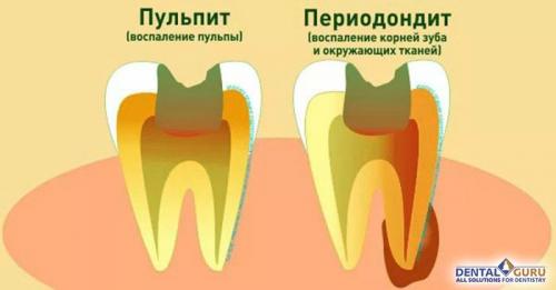 Воспаление пульпы зуба. Краткое описание