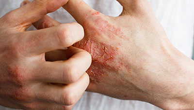 Бляшки и красные пятна на коже болезни,кожа,медицина и здоровье