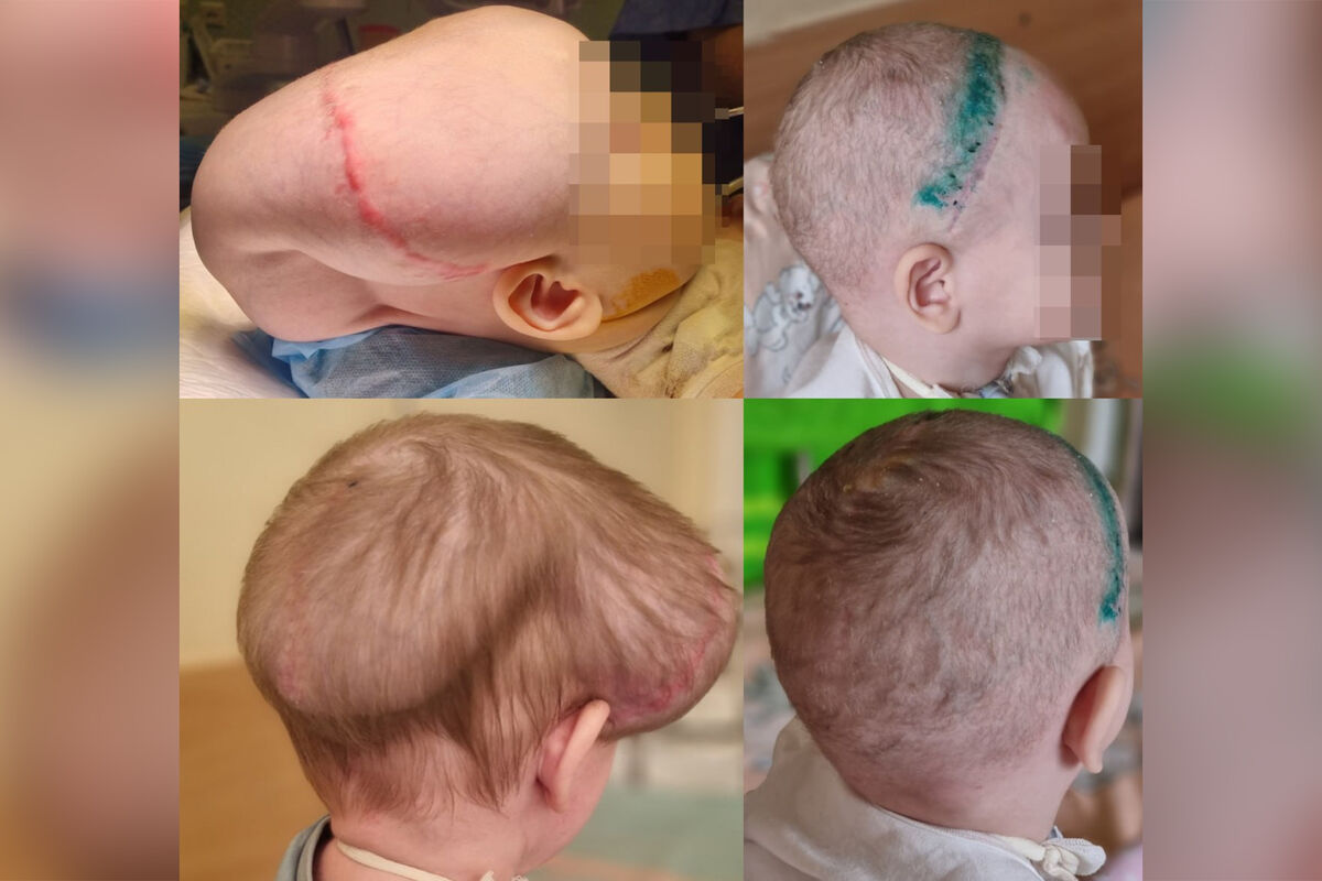 В Москве хирурги устранили гигантскую деформацию головы двухлетней девочке