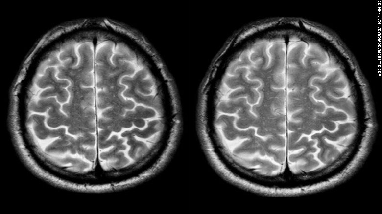 Состояние мозга до и после короткой миссии / ©NEJM