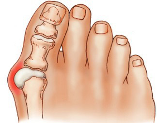 Халюс Валгус