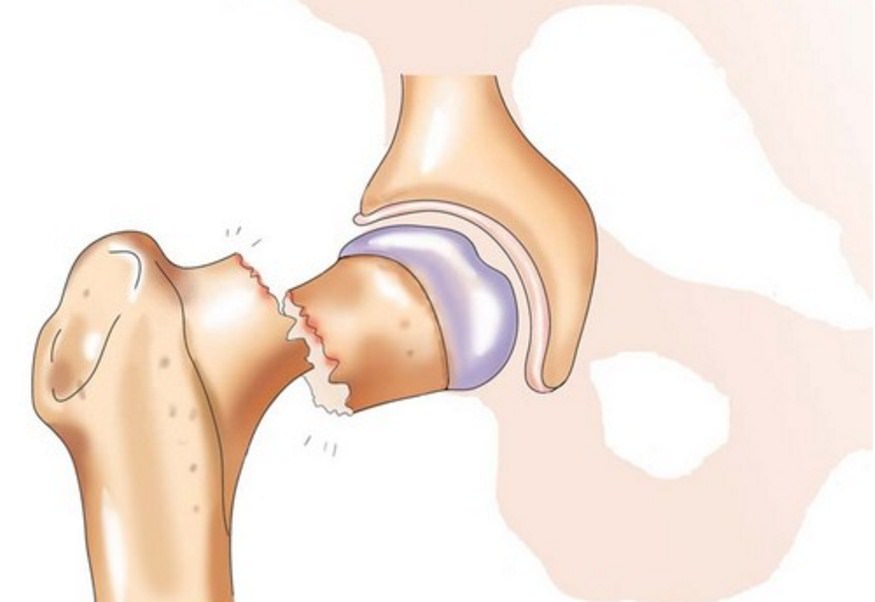 Шейка бедра перелом в пожилом возрасте фото