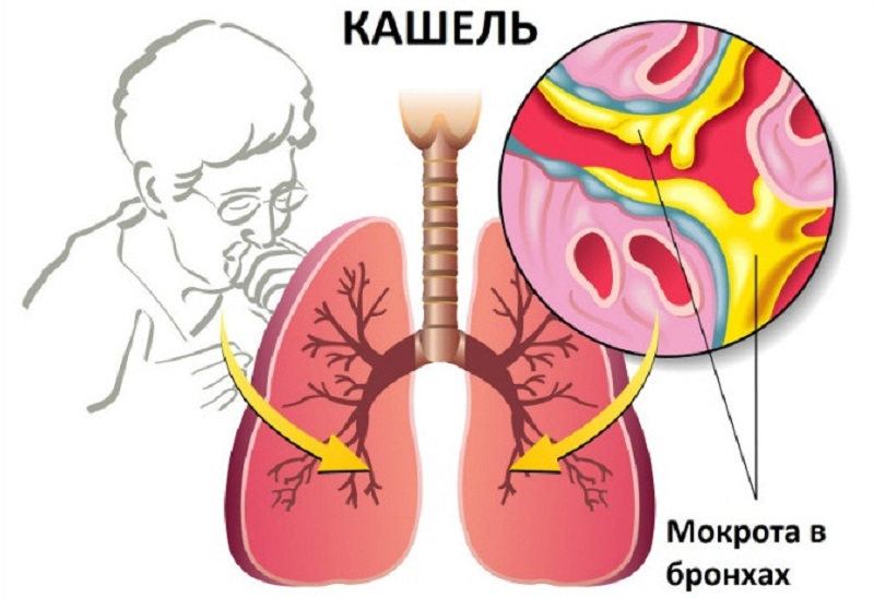 как вывести мокроту из легких в домашних условиях