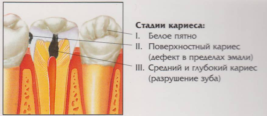 Флюороз — противоположность кариеса  здоровье,здоровье зубов,зубы,медицина,пятна,стоматология,флюороз,фтор,эмаль