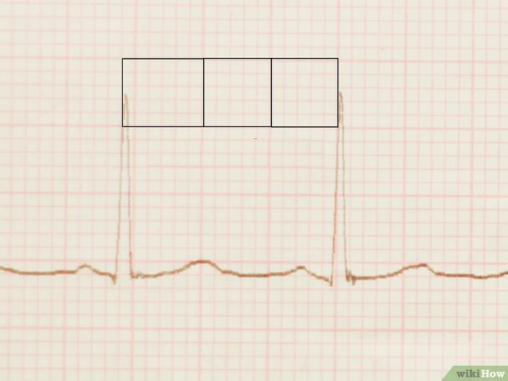 Изображение с названием Read an EKG Step 4