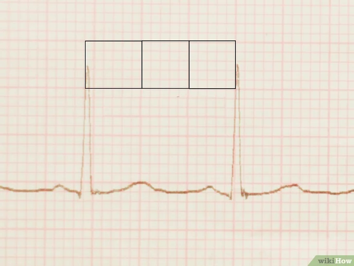 Как прочитать ЭКГ сердца, между, секунды, квадратов, пиков, время, пиками, количество, потому, больших, ничего, когда, соответственно, аритмия, длина, после, просто, своей, квадраты, сердцебиения