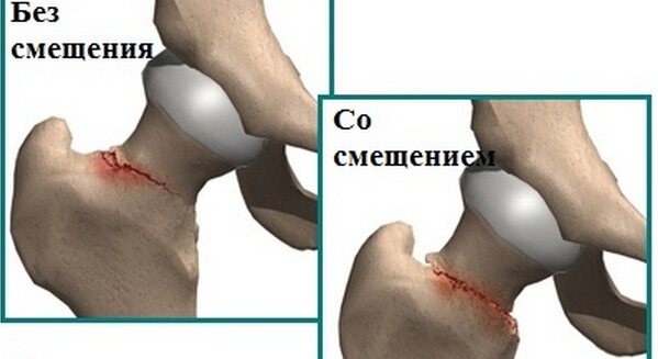 Сколько живут пациенты в пожилом возрасте с переломом шейки бедра бедра, шейки, перелома, кости, пожилом, может, пожилых, возрасте, бедренной, перелом, травмы, после, людей, лечение, области, переломы, переломов, повреждения, костной, пациент