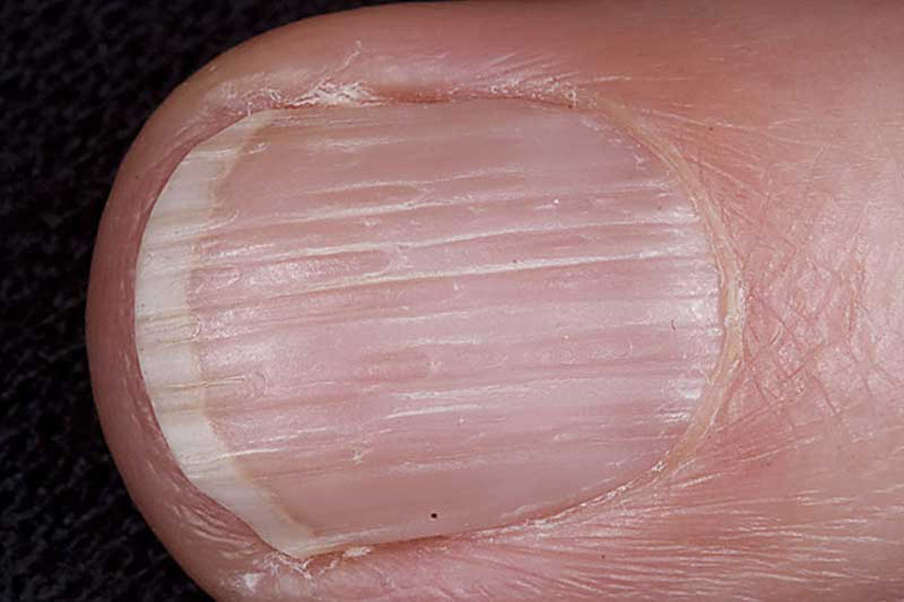 Поперечная бороздка на ногте (одна) болезнь, организм