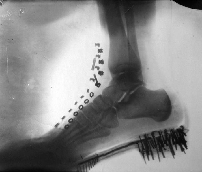 Рентгеновский снимок, сделанный Теслой в конце 1880-х г.