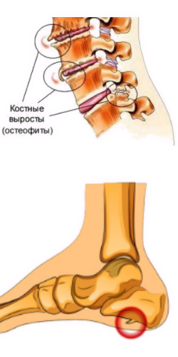 Пяточная шпора или плантарный фасциит