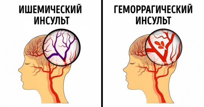 Как распознать инсульт: первые признаки, факторы риска и первая помощь болезни,здоровье,инсульт,первая помощь,признаки,симптомы