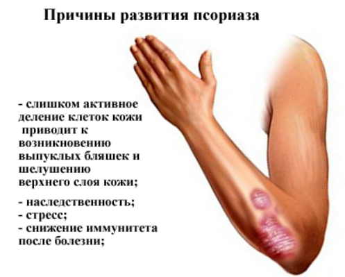 Как муж от псориаза излечился: простой рецепт и безвредный!